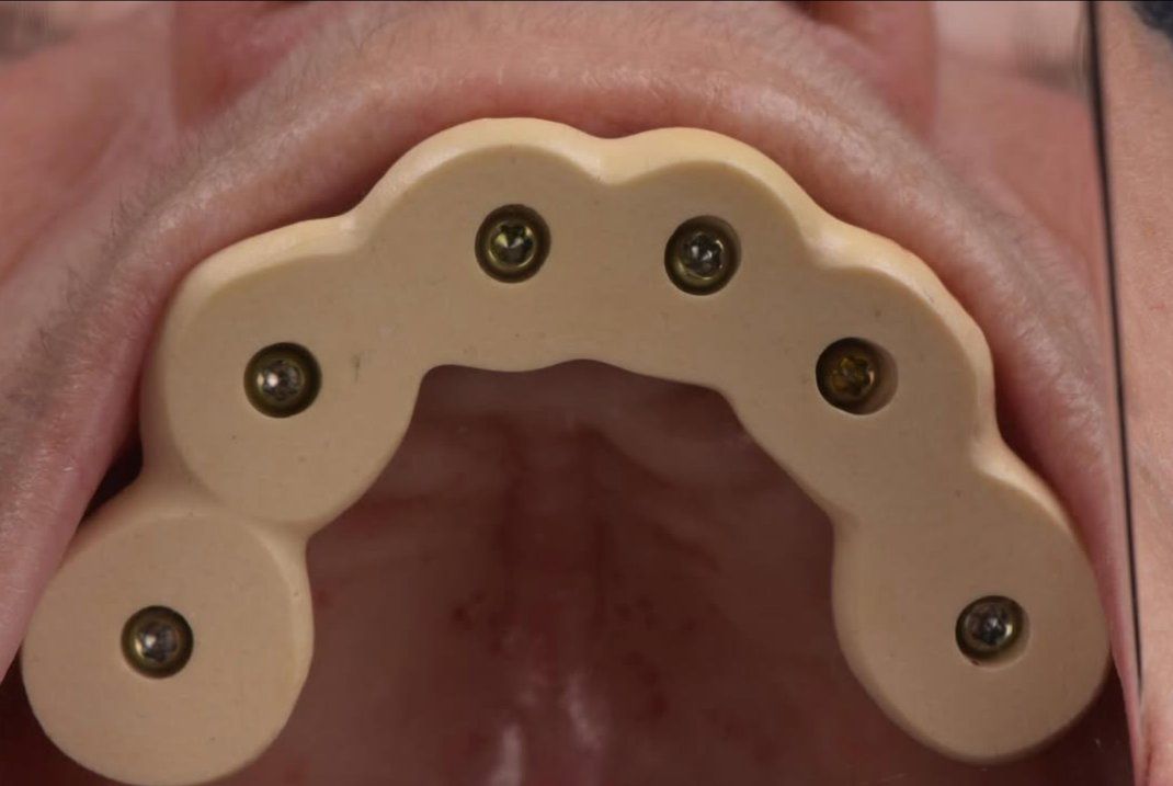 Vérification de l'armature sur implants